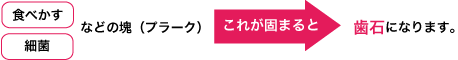 食べかす、細菌などの塊（プラーク）が固まると歯石になります