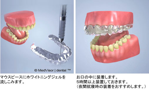 マウスピースにホワイトニングジェルを流しこみ、お口の中に装着します。５時間以上装置しておきます。