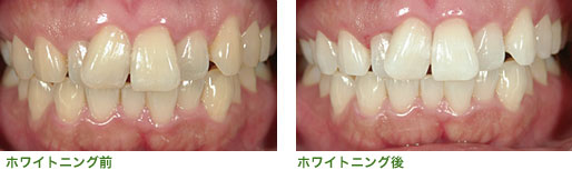 ホワイトニングの施術前後比較